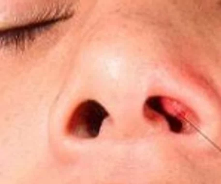 Фурункул носа: симптомы и диагностика